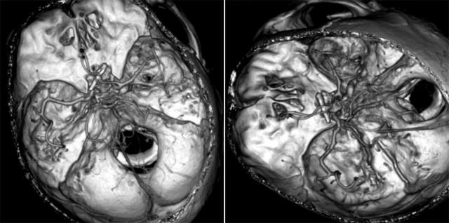 平時(shí)不注意甲醛超標(biāo)，50歲女子劇烈頭痛、惡心干嘔，一查已是癌癥晚期！